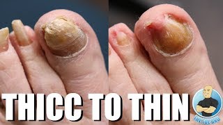 CRAZY THICK NAIL TRANSFORMATION BEFORE amp AFTER [upl. by Sussna]