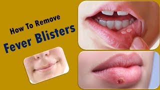 How to Get Rid of Fever Blisters Fast  how to remove fever blisters [upl. by Ratcliff]