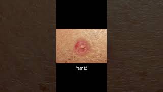 Basal Cell Carcinoma Skin Cancer Development Time Lapse Normal to Cancer Over 25 Years [upl. by Eulalee]