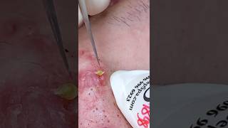 P001  SacDepSpa acne pimple sacdepspa blackheads [upl. by Anirtac238]