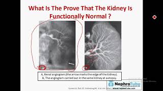 Hepatorenal Syndrome English Language  Dr Gawad [upl. by Notreve]