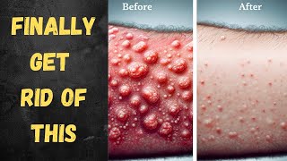 How I Got Rid of My Keratosis Pilaris on my Arms [upl. by Eemia]