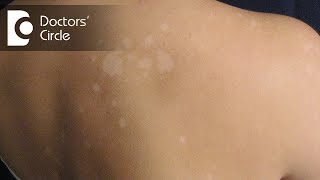 Managing round irregular skin patches not responding to topical creamsDr Rasya Dixit [upl. by Nabi44]