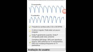 WPW com fibrilacao atrial [upl. by Chill]