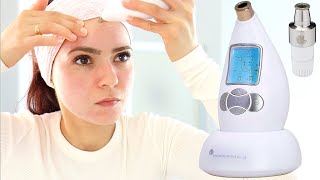 Microderm Glo Review amp How To Use  Microdermabrasion DIY Facial Treatment For Clear Skin [upl. by Thorstein]