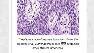 mycosis fungosis [upl. by Eirol290]