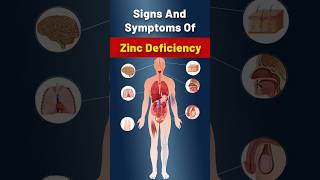 Zinc Deficiency  What Are The Critical Symptoms Of Zinc Deficiency zincdeficiency zinc [upl. by Maker716]