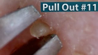 11 Pull Out Blackheads Close up  Blackheads Removal [upl. by Rikahs]