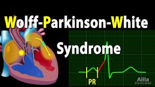 WolffParkinsonWhite Syndrome Pathophysiology PreExcitation and AVRT Animation [upl. by Prichard677]