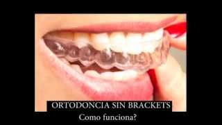 como funciona la Ortodoncia Sin Brackets [upl. by Liuqnoj]