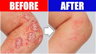 Psoriasis Relief The Best Remedy For Your Skin [upl. by Cosimo503]