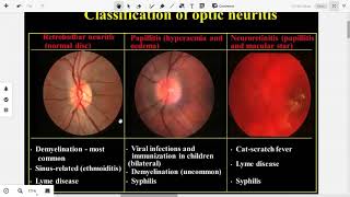 Papilledema and Papillitis 3 [upl. by Direj]