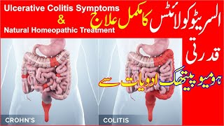 Ulcerative Colitis Treatment  Homeopathic Treatment of Ulcerative Colitis [upl. by Llednol]