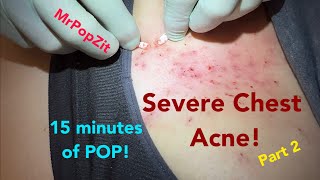 Dozens of clogged pores over the sternum extracted Blackheads whiteheads removed [upl. by Lledal191]