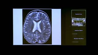 Aicardi Goutières Syndrome  Dr Yanick Crow University of Edinburgh MRC Human Genetics Unit [upl. by Aicemat842]