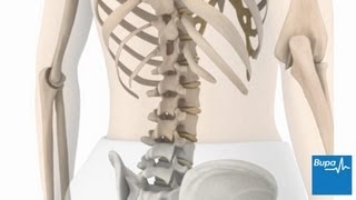 How idiopathic scoliosis occurs  Bupa Health [upl. by Iroak653]