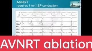 AVNRT ablation avnodalreentrytachycardia EPstudy bestcardiology [upl. by Annayad19]