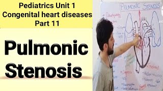 pulmonary stenosis  valvular sub and supravalvular  pathophysiology symptoms and treatment [upl. by Nosreh352]