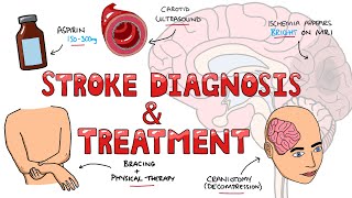 Stroke Diagnosis and Treatment  Acute and Long Term Treatment of Ischemic and Hemorrhagic Stroke [upl. by Calmas]