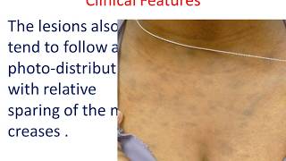 10 MIN REVISION Ashy Dermatosis A confusing hyperpigmentation [upl. by Ostap38]