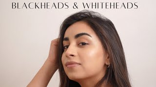 WHITEHEADS amp BLACKHEADS DR RIYA [upl. by Brok]