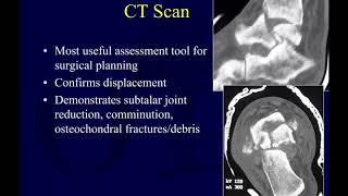 Talus fractures 1  assessment OTA lecture series III l14a [upl. by Thorner861]