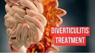 How To Treat Diverticulitis in 2024 [upl. by Darci]