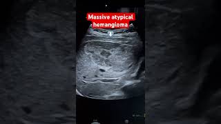 Large atypical liver hemangioma Ultrasound  MRI proved  large benign hepatic mass  ARDMS [upl. by Airreis]