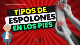 TIPOS DE ESPOLONES EN LOS PIES O EL TALÓN 👣 [upl. by Ion552]