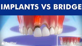 Dental Implants VS Tooth bridge  Comparison © [upl. by Tnarud]