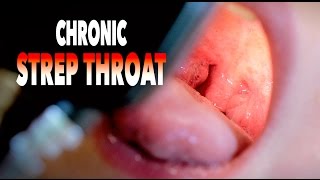 CHRONIC STREP THROAT  Cute Baby Alert  Dr Paul [upl. by Eltsyek]