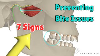 Preventing bite Issues 7 Critical Signs to assess before restoring a posterior tooth [upl. by Norad]