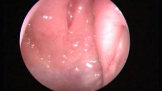 Video 1 Normal nasal endoscopy [upl. by Autrey]