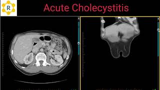 Cholecystitis [upl. by Herschel30]