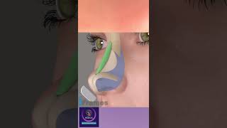 Augmentation Rhinoplasty Surgery 3D animation [upl. by Rudich]