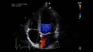 Pulmonary Stenosis [upl. by Archer28]