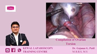 Ovarian Torsion by Dr Gajanan Patil  Kewal Hospital  Laparoscopy Training [upl. by Ilatfen425]