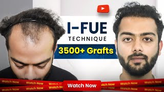 Hair Transplant in Bhopal  Cost of Hair Transplant in Bhopal  Hair Transplant Doctor in Bhopal [upl. by Norrehs763]