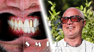 Ceri From Wales Got His Teeth Done In Turkey  Dental Wise Turkey [upl. by Anayik682]