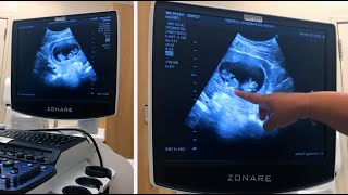 SURPRISE ULTRASOUND TWINS  Twins on Ultrasound Reaction [upl. by Hallett]