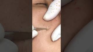 Best Pimple Popping 13 reels beautiful blackheads sacdepspa cute health [upl. by Annaeed]