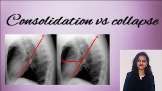 Chest X ray  How to differentiate consolidation from collapse [upl. by Ueihttam]