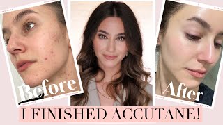 I FINISHED ACCUTANE 🎉 Results  Side Effects Low Dose Isotretinoin Journey  Karima McKimmie [upl. by Enahc]