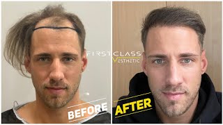 Hair Transplant Growth Timeline  Day 1 To Day 365 Before amp After  FirstClassEsthetic in Turkey [upl. by Marijn]