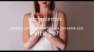 Vitiligo en adolescentes [upl. by Yelrahs45]