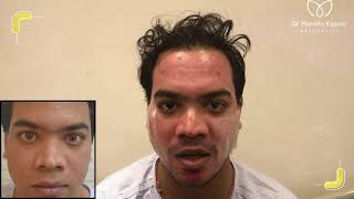 Dermabrasion Skin Treatment  Acne Scar Treatment in Delhi India [upl. by Kuth]