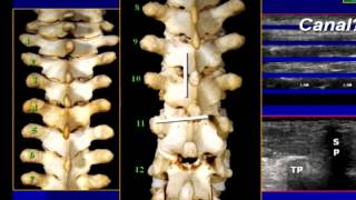 Regional Anesthesia  Sonoanatomy II Truncal Spine and Paravertebral Regions [upl. by Inaflahk435]