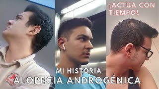 MI HISTORIA con la ALOPECIA ANDROGÉNICA CON FOTOS  17 A 23 AÑOS 🙇‍♂️🕟 [upl. by Susy]