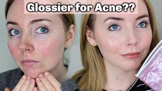 Glossier for Acne Prone Skin  Does it Work My Tips [upl. by Ashbaugh]