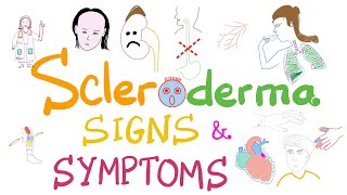 Scleroderma Pathogenesis and Clinical Manifestations Detailed Explanation [upl. by Maryann757]